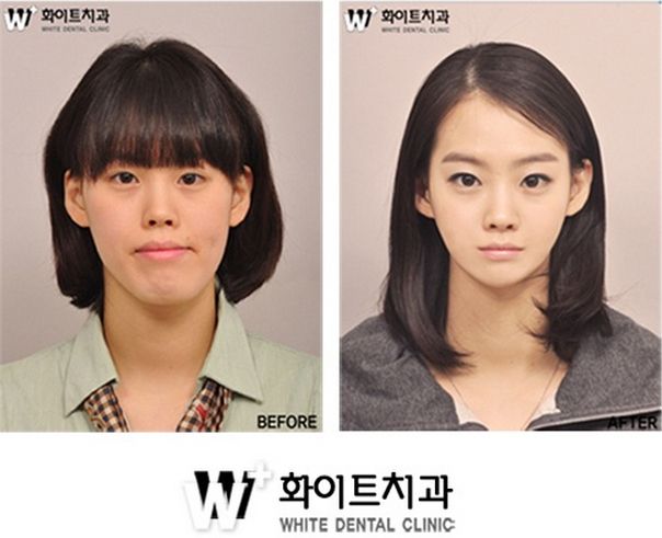Double Eyelid Surgery in Korea: The Secret to Natural, Beautiful Eyes